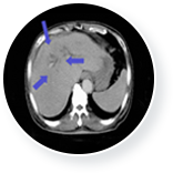 간암 치료 후  이미지