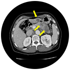 췌장암 치료 전 이미지