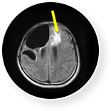 뇌종양 치료 전 이미지