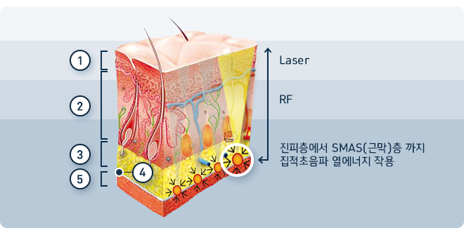 진피층에서 SMAS(근막)층까지 집적초음파 열에너지 작용 관련 이미지