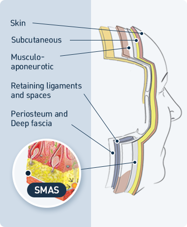 더블로 시술원리 관련 이미지
