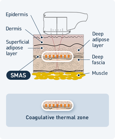 더블로 시술원리 관련 이미지