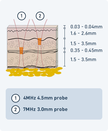 더블로 시술원리관련 이미지