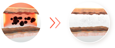 피코플러스 레이저 관련 이미지